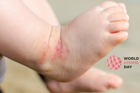 #UniteForAtopicEczema – Svjetski dan atopijskog dermatitisa